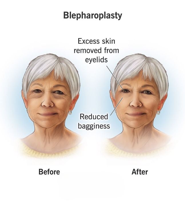 Blepharoplasty (Eyelid Surgery)